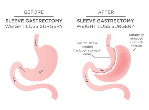 healthy how do you know if you stretched your gastric sleeve